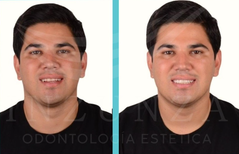 Armonización Dental en Culiacán